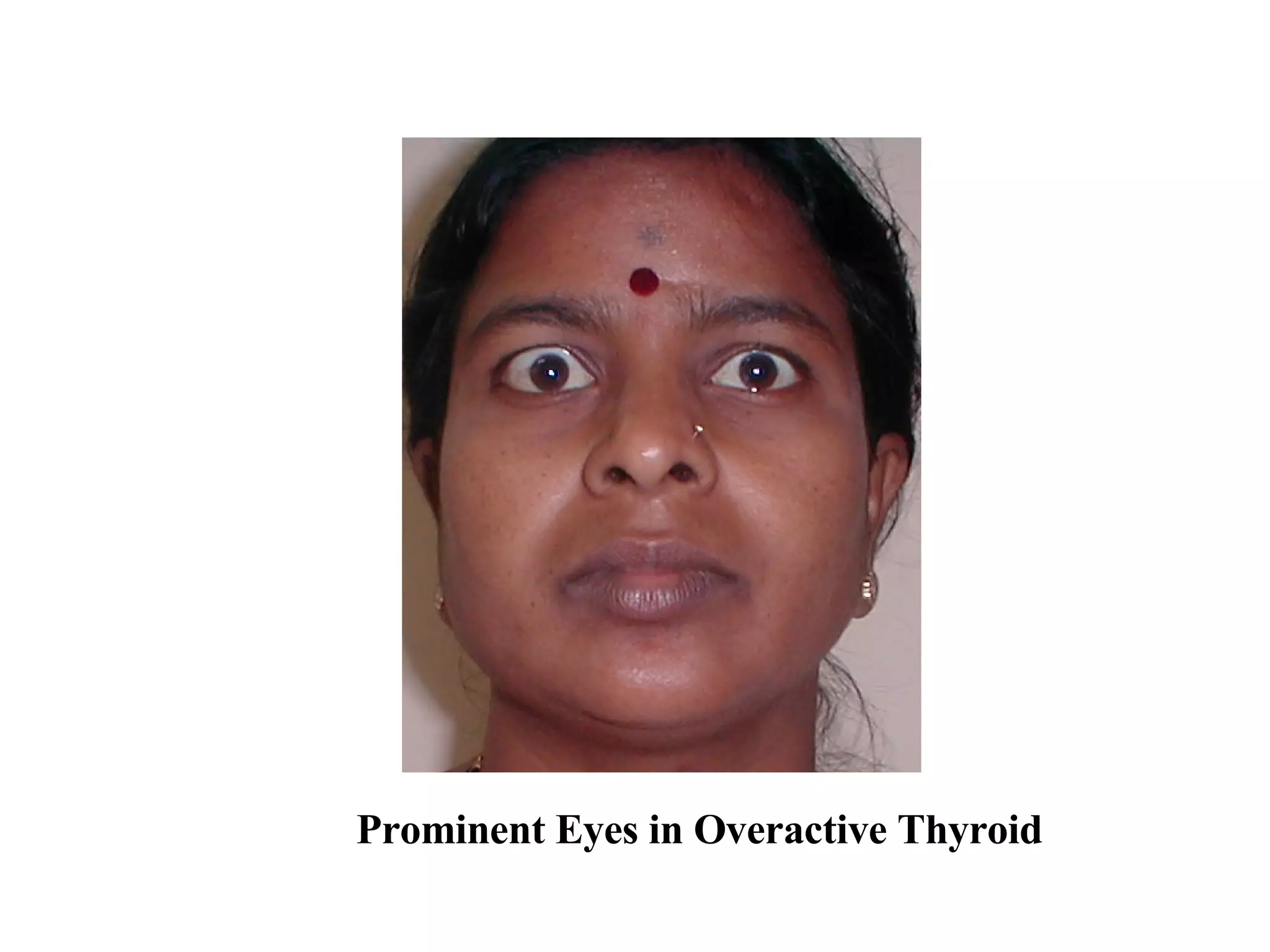 Prominent Eyes in Overactive Thyroid