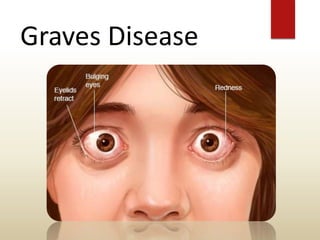 Graves Disease
 