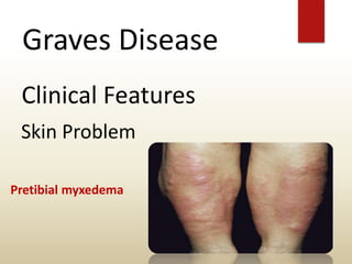 Graves Disease
Clinical Features
Skin Problem
Pretibial myxedema
 