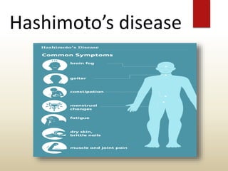 Hashimoto’s disease
 