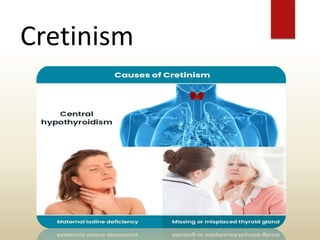 Cretinism
 