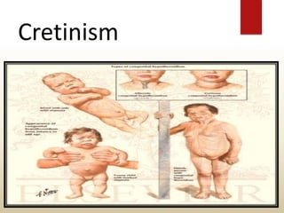Cretinism
 