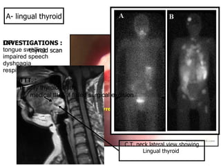 C/P : tongue swelling impaired speech dyshpagia respiratory obestruction A- lingual thyroid INVESTIGATIONS : thyroid scan C.T. neck lateral view showing Lingual thyroid  TTT. : IF  only thyroid tissue    medical ttt. & if failed surgical excision 