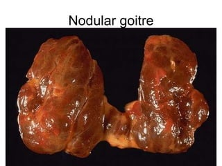 Nodular goitre 