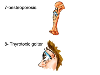 7-oesteoporosis. 8- Thyrotoxic goiter 