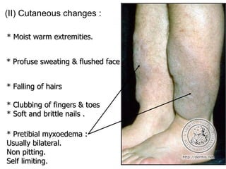 (II) Cutaneous changes : * Moist warm extremities. * Profuse sweating & flushed face * Falling of hairs * Clubbing of fingers & toes * Soft and brittle nails . * Pretibial myxoedema :  Usually bilateral. Non pitting. Self limiting. 