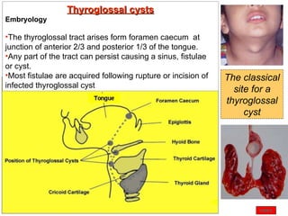 INDEX The classical site for a thyroglossal cyst Thyroglossal cysts Embryology The thyroglossal tract arises form foramen caecum  at junction of anterior 2/3 and posterior 1/3 of the tongue.  Any part of the tract can persist causing a sinus, fistulae or cyst.  Most fistulae are acquired following rupture or incision of infected thyroglossal cyst   
