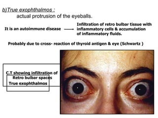 b)True exophthalmos :   actual protrusion of the eyeballs. It is an autoimmune disease Infiltration of retro bulbar tissue with  inflammatory cells & accumulation  of inflammatory fluids.  Probably due to cross- reaction of thyroid antigen & eye (Schwartz ) C.T showing infiltration of  Retro bulbar spaces True exophthalmos 