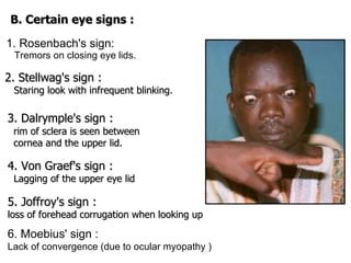 1. Rosenbach's sign:     Tremors on closing eye lids. B. Certain eye signs : 2. Stellwag's sign : Staring look with infrequent blinking. 3. Dalrymple's sign :   rim of sclera is seen between    cornea and the upper lid. 4. Von Graef's sign :   Lagging of the upper eye lid 5. Joffroy's sign :   loss of forehead corrugation when looking up  6. Moebius' sign :   Lack of convergence (due to ocular myopathy ) 