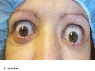 Lid retraction 
