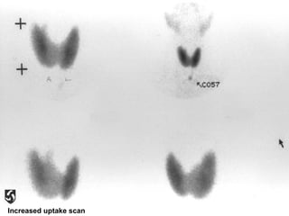 Increased uptake scan 