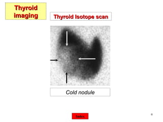 ©  Thyroid Isotope scan Cold nodule Index Thyroid imaging 