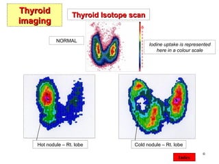©  Index Thyroid imaging NORMAL Iodine uptake is represented here in a colour scale Hot nodule – Rt. lobe Cold nodule – Rt. lobe Thyroid Isotope scan 