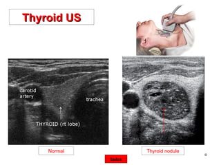 ©  Thyroid US Index Normal Thyroid nodule 