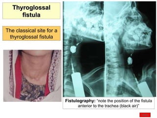 Fistulography:   “note the position of the fistula anterior to the trachea (black air)” The classical site for a thyroglossal fistula Thyroglossal fistula INDEX 