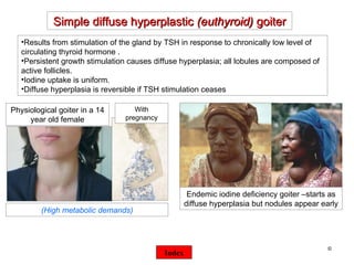 ©  Physiological goiter in a 14 year old female Simple diffuse hyperplastic  (euthyroid)  goiter Results from stimulation of the gland by TSH in response to chronically low level of circulating thyroid hormone . Persistent growth stimulation causes diffuse hyperplasia; all lobules are composed of active follicles.  Iodine uptake is uniform. Diffuse hyperplasia is reversible if TSH stimulation ceases With pregnancy (High metabolic demands) Index Endemic iodine deficiency goiter –starts as diffuse hyperplasia but nodules appear early 