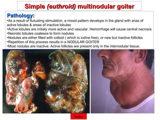 ©  Simple  (euthroid)  multinodular goiter Pathology:  As a result of flutuating stimulation, a mixed pattern develops in the gland with arias of active lobules & areas of inactive lobules Active lobules are initialy more active and vascular. Hemorrhage will cause central necrosis Necrotic lobules coalesce to form nodules Nodules are either filled with colloid ( which is iodine free), or new but inactive follicles Repetition of this process results in a NODULAR GOITER Most nodules are inactive. Active follicles are present only in the internodular tissue.  Index 