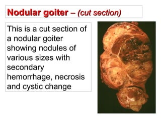 ©  Nodular goiter  – (cut section) This is a cut section of a nodular goiter showing nodules of various sizes with secondary hemorrhage, necrosis and cystic change 