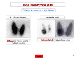©  Toxic  (hyperthyroid)  goiter 1ry (Graves disease) 2ry nodular goiter Hot nodule  in 2ry nodular toxic goiter Diffuse  and intense uptake of radioctive iodine Different appearance in thyroid scan Index 
