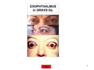 ©  EXOPHTHALMUS in GRAVS Ds. Index 