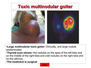 ©  Large multinodular toxic goiter:  Clinically, one large nodule predominates Thyroid scan shows:  Hot nodules on the apex of the left lobe and on the middle of the right lobe and cold nodules on the right lobe and on the isthmus. The treatment is surgical Toxic multinodular goiter Index 