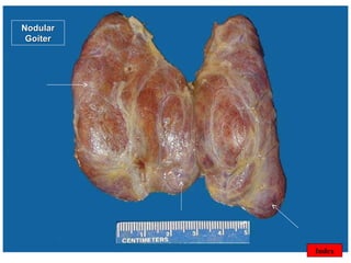 ©  Index Nodular Goiter 