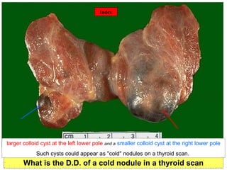 ©  Simple nodular goiter What is the D.D. of a cold nodule in a thyroid scan Index larger colloid cyst at the left lower pole  and a   smaller colloid cyst at the right lower pole Such cysts could appear as "cold" nodules on a thyroid scan.  Index 