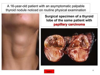 ©  A 16-year-old patient with an asymptomatic palpable thyroid nodule noticed on routine physical examination Surgical specimen of a thyroid lobe of the same patient with  papillary carcinoma Index 