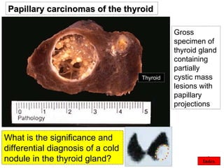 ©  Gross specimen of thyroid gland containing partially cystic mass lesions with papillary projections  What is the significance and differential diagnosis of a cold nodule in the thyroid gland? Papillary carcinomas of the thyroid  Thyroid Index 