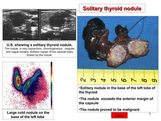 ©  Solitary nodule   in the  base of the left lobe  of the thyroid The nodule   exceeds the anterior margin of the capsule The nodule proved to be malignant   U.S. showing a solitary thyroid nodule.  The nodule  is very hypoechoic, inhomogeneous;  irregular  and vague borders, Anterior margin of the capsule looks broken by the nodule   Large cold nodule on the base of the left lobe   Solitary thyroid nodule Index 