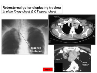 ©  Retrosternal goiter displacing trachea  in plain X-ray chest & CT upper chest Index 