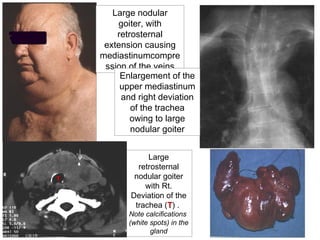 ©  Large nodular goiter, with retrosternal extension causing mediastinumcompression of the veins Enlargement of the upper mediastinum and right deviation of the trachea owing to large nodular goiter Large retrosternal nodular goiter with Rt. Deviation of the trachea ( T ) .  Note calcifications  (white spots) in the gland T 