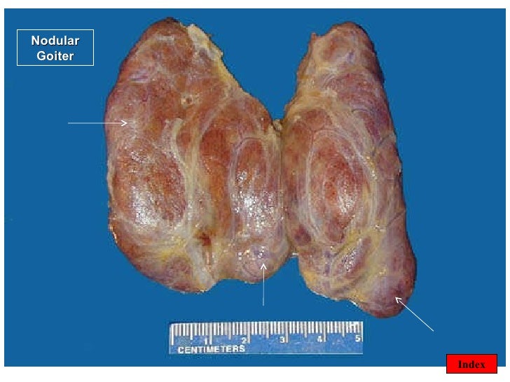 Multi goiter thyroid