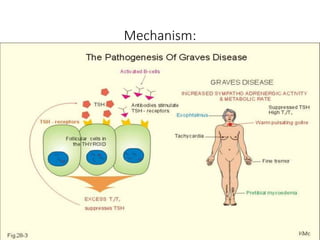 Mechanism:
• Thyroid Stimulating Immunoglobulins (TSIs) bind to the TSH receptor
and mimic the action of TSH.
• Activates adenylate cyclase and the formation of cAMP.
• Genetic factor: MHC class II antigen HLA-DR3 increases risk by 3 fold
 