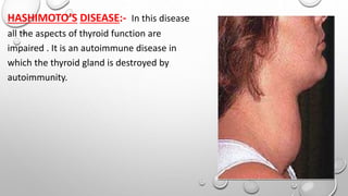 HASHIMOTO’S DISEASE:- In this disease
all the aspects of thyroid function are
impaired . It is an autoimmune disease in
which the thyroid gland is destroyed by
autoimmunity.
 