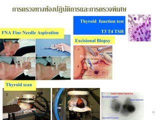 Thyroid function test
T3 T4 TSH
Thyroid scan
FNA Fine Needle Aspiration
Excisional Biopsy
การตรวจทางห้องปฏิบัติการและการตรวจพิเศษ
11/29/2010 12rangsima@chiangmai.ac.th
 