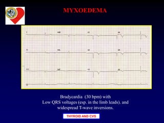 THYROID AND CVS
Bradycardia (30 bpm) with
Low QRS voltages (esp. in the limb leads). and
widespread T-wave inversions.
MYXOEDEMA
 