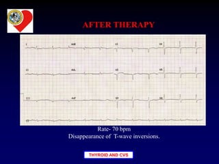 THYROID AND CVS
AFTER THERAPY
Rate- 70 bpm
Disappearance of T-wave inversions.
 