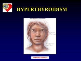 THYROID AND CVS
HYPERTHYROIDISM
 