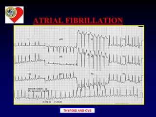 THYROID AND CVS
ATRIAL FIBRILLATION
 