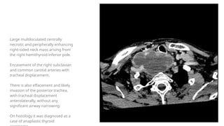 Thyroid and parathyrid imaging radiological findings.pptx