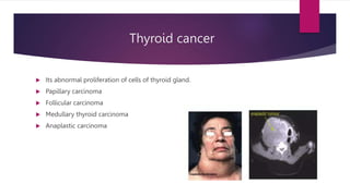 Thyroid cancer
 Its abnormal proliferation of cells of thyroid gland.
 Papillary carcinoma
 Follicular carcinoma
 Medullary thyroid carcinoma
 Anaplastic carcinoma
 