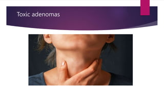 Toxic adenomas
 