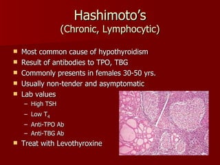 Hashimoto’s (Chronic, Lymphocytic) Most common cause of hypothyroidism Result of antibodies to TPO, TBG Commonly presents in females 30-50 yrs. Usually non-tender and asymptomatic Lab values High TSH Low T 4 Anti-TPO Ab Anti-TBG Ab Treat with Levothyroxine 