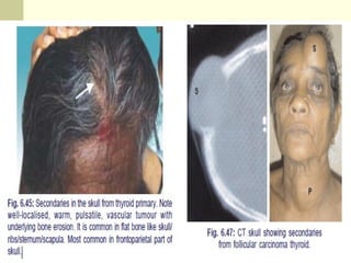 Follicular CarcinomaFollicular Carcinoma
 Account for 10% of all thyroid cancers.
 More common in I-deficient areas.
 Female:male ratio is 3:1
 Mean age at presentation is 50 yrs.
 Solitary thyroid nodule, rapid increase in size and long-
standing goiter.
 Hyperfunctioning < 1%. (S&S of Thyrotoxicosis)
 Far-away metastasis (spreads hematogenously)
 Female (3 to 1 ratio)
 Favorable prognosis
 