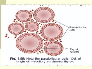 MEDULLARY CARCINOMA
 It is uncommon (5%) type of thyroid malignancy.
 It arises from the parafollicular ‘C’ cells/ AD
 Associated with MEN-II
 Tumour also secretes 5-H.T. (serotonin), Prostaglandin,
ACTH and vasoactive intestinal polypeptide (VIP).
CLINICAL FEATURES:
 Thyroid swelling often with enlargement of neck lymph node.
 Diarrhea, flushing (30%), Hypertension.
 
