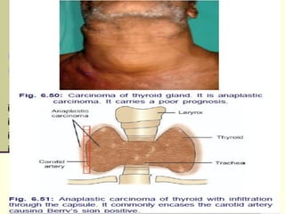 Anaplastic Cancer
 It occurs in elderly.
 It is a very aggressive tumor of short duration, presents with a
swelling in thyroid region which is rapidly progressive causing
—
i. Stridor and hoarseness of voice due to tracheal obstruction.
ii. Dysphagia.
iii. Fixity to the skin.
iv. Positive Berry’s sign—involvement of carotid sheath leads to
absence of carotid pulsation.
 