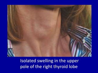 Isolated swelling in the upper
pole of the right thyroid lobe
 