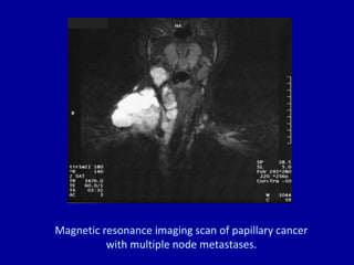Magnetic resonance imaging scan of papillary cancer
with multiple node metastases.
 
