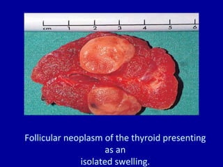 Follicular neoplasm of the thyroid presenting
as an
isolated swelling.
 